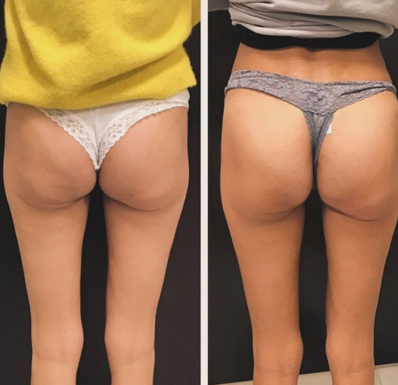 Butt Augmentation