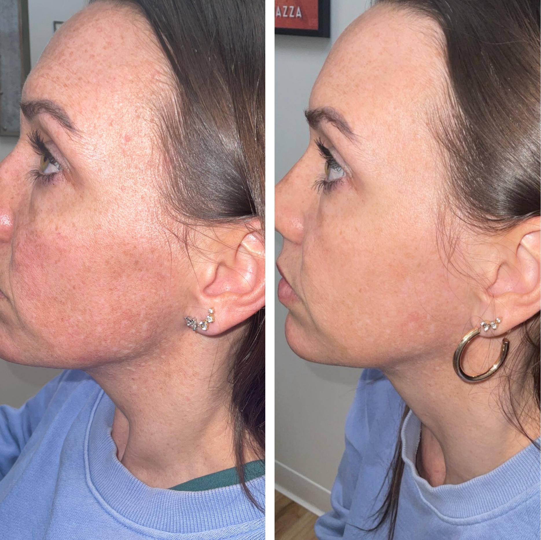 Moxi for Melasma